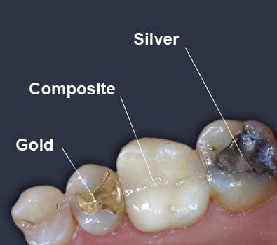 Replacing Old Fillings